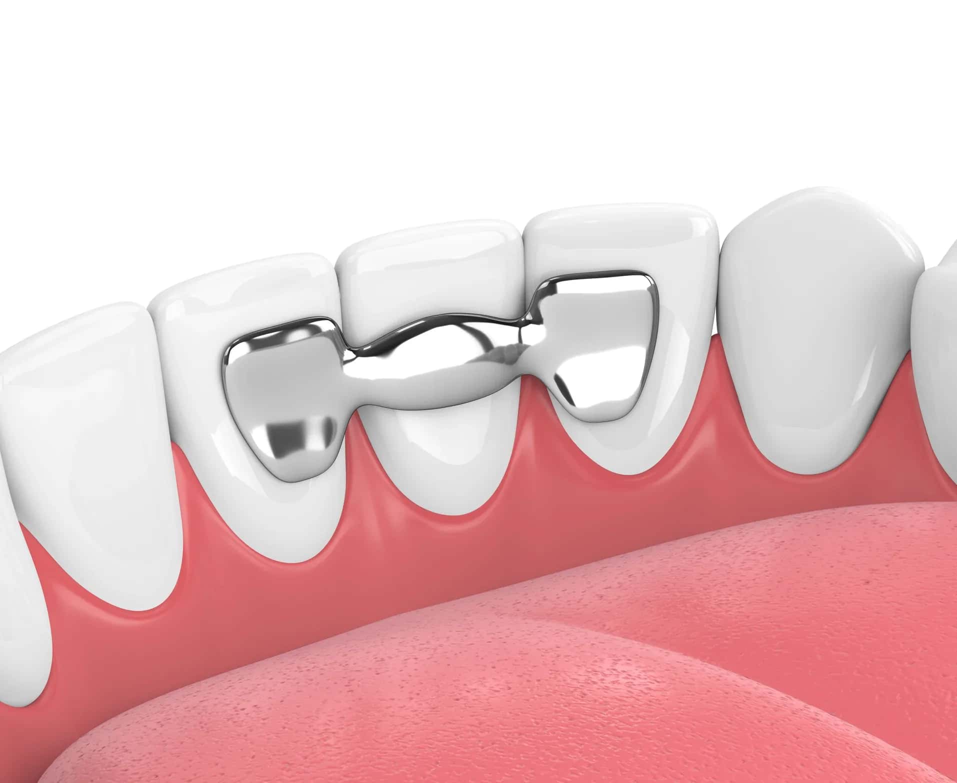 How Much Does a Dental Bridge Cost in 2026?