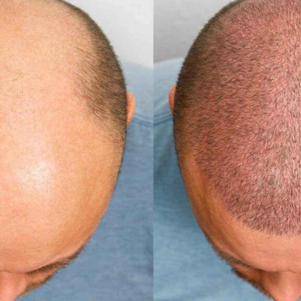 Hair Transplant Clinics in UK