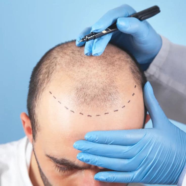 Hair Transplant